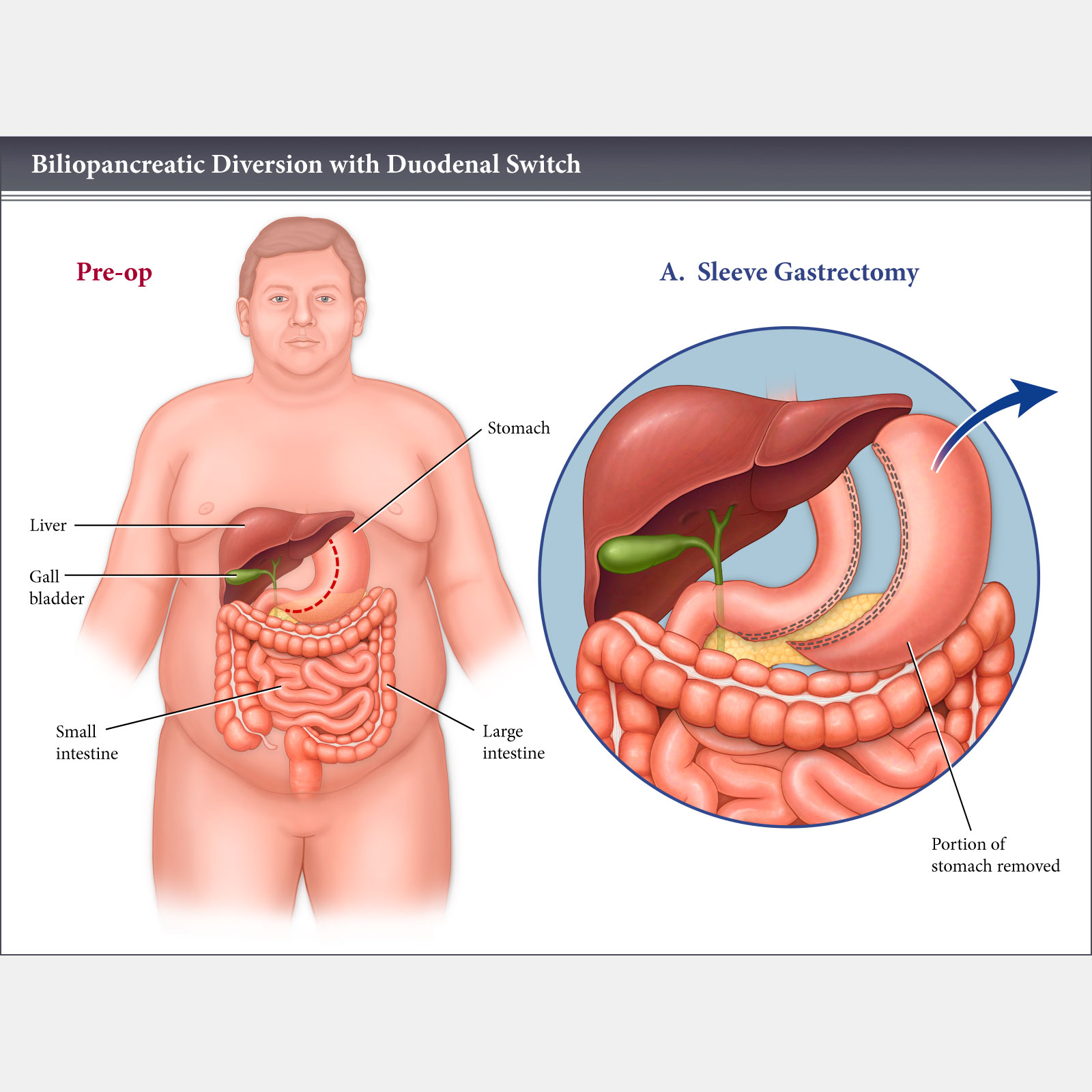 Biliopancreatic Diversion with Duodenal Switch