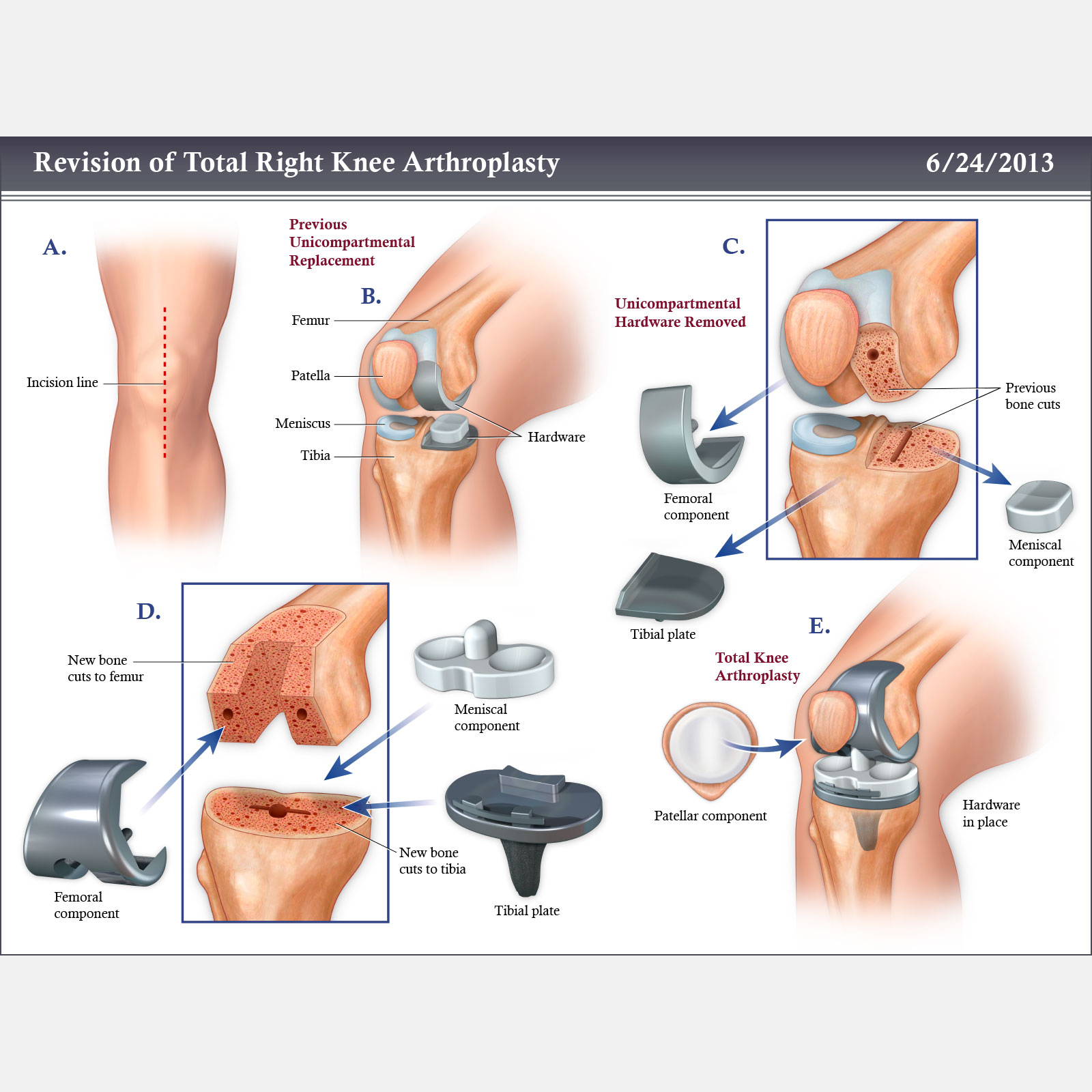 Total Knee Arthroplasty