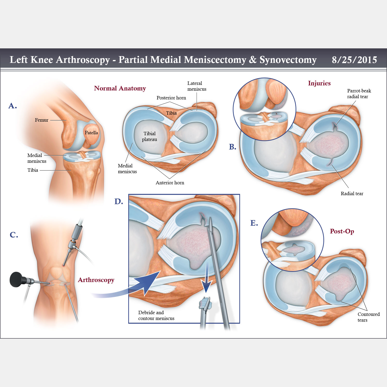 Left Knee Arthroscopy