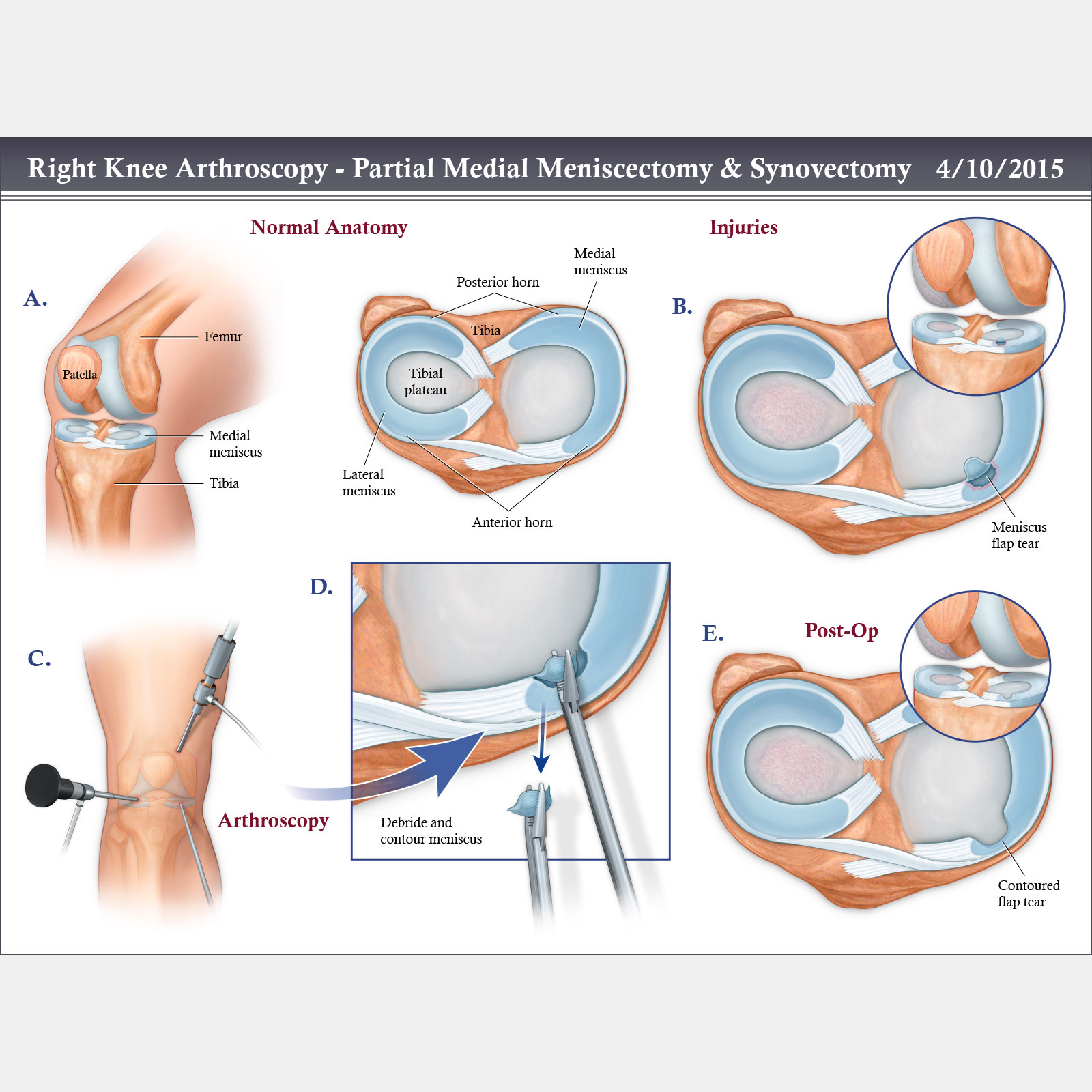 Right Knee Arthroscopy