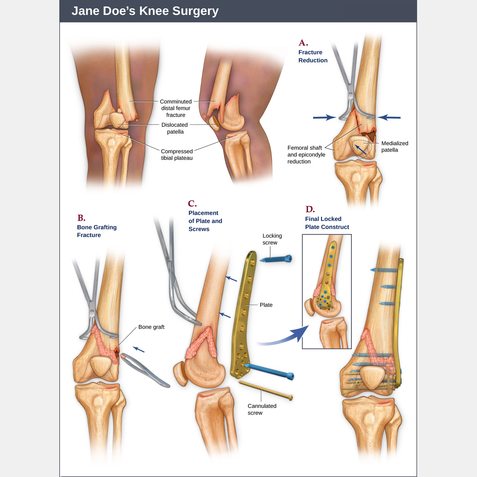 Knee Injuries