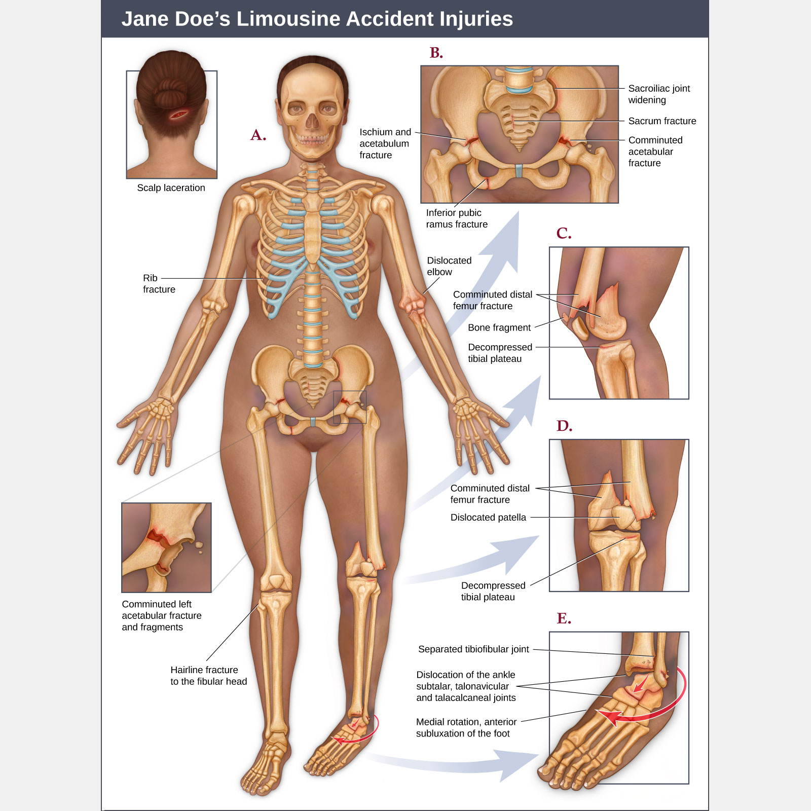 Limousine Accident Injuries