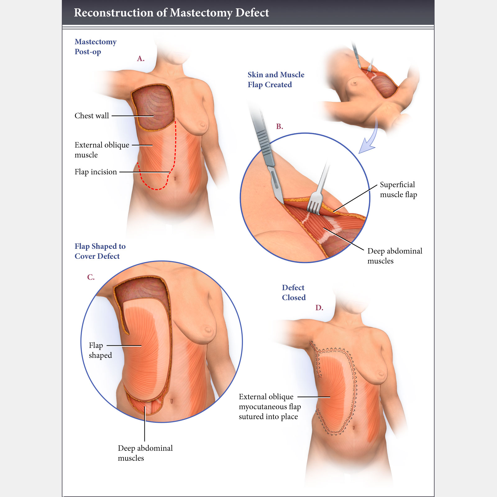 Reconstrustion of Mastectomy Defect