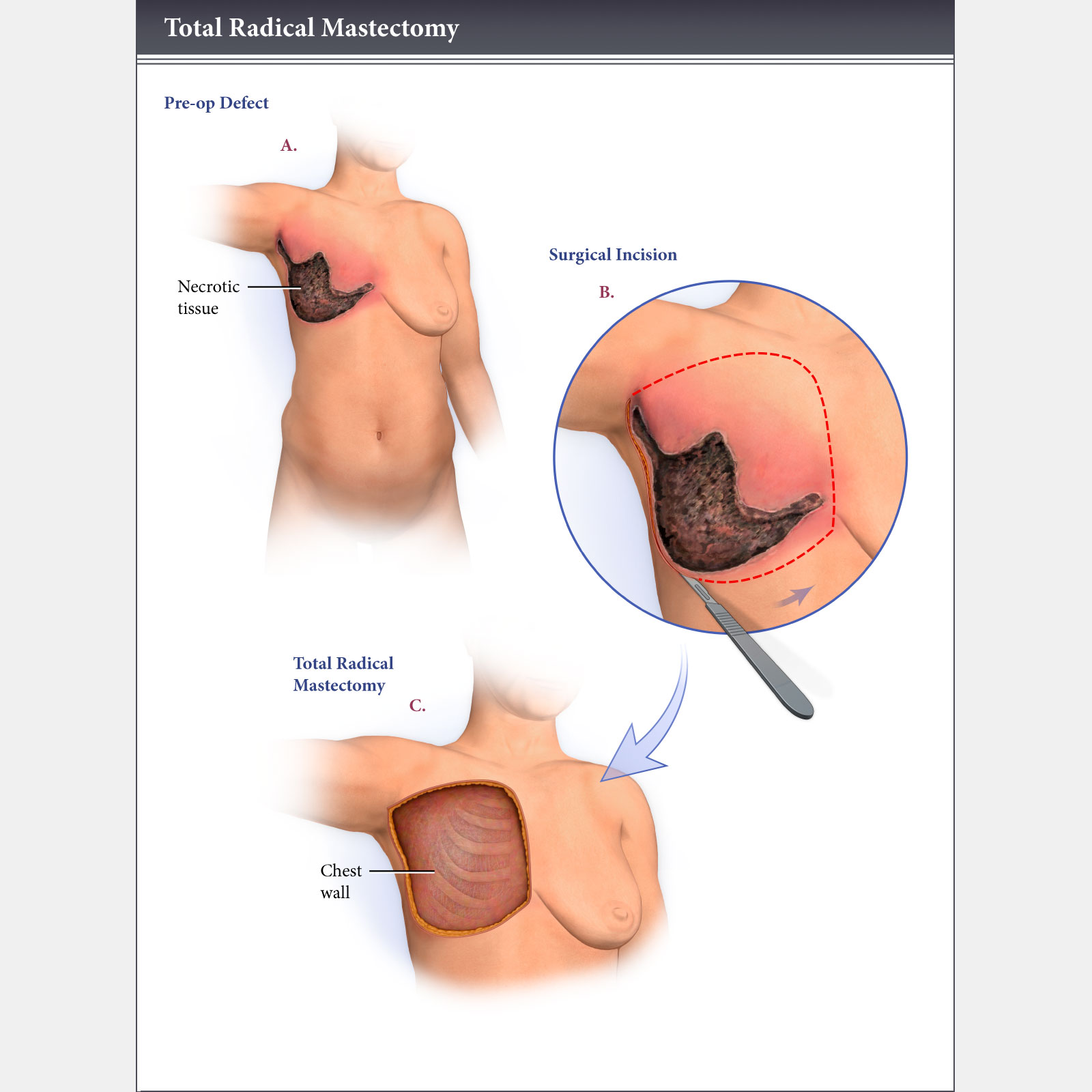 Total Radical Mastectomy