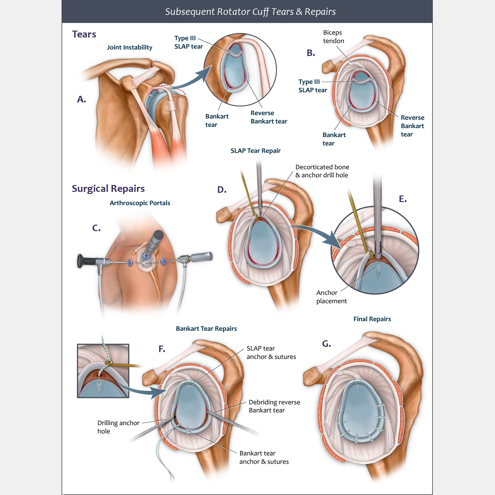 Subsequent Rotator Cuff Tears & Repairs