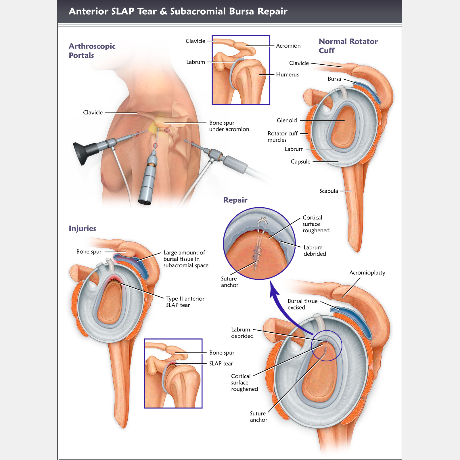 Anterior SLAP Tear & Subacromial Bursa Repair