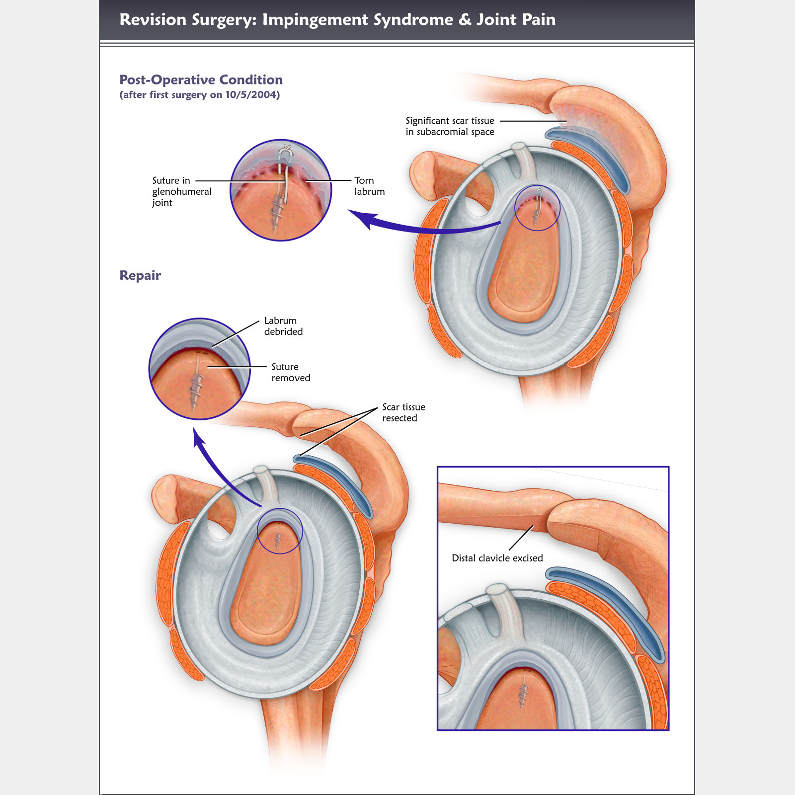 Impingement Syndrome & Joint Pain