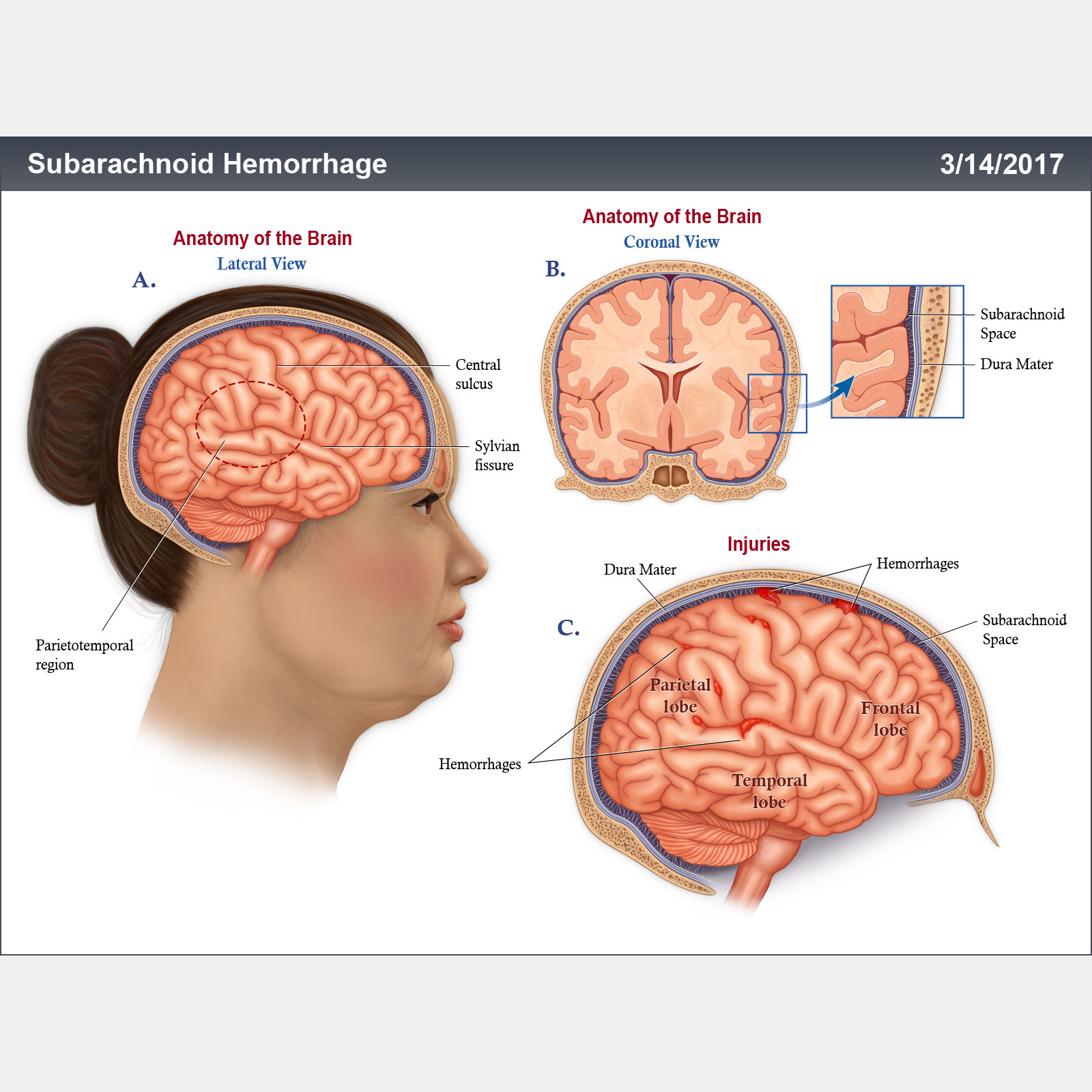 Subarachnoid Hemorrhage