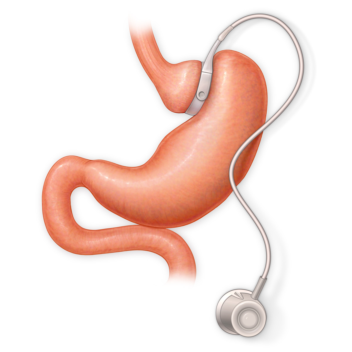 Adjustable Gastric Lap Band