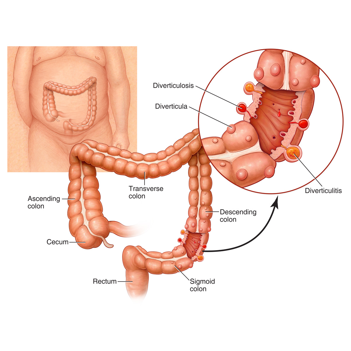Diverticulitis