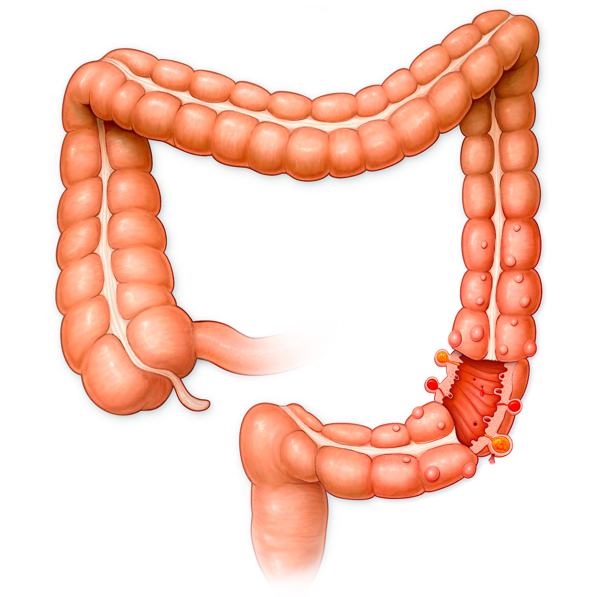 Diverticulitus