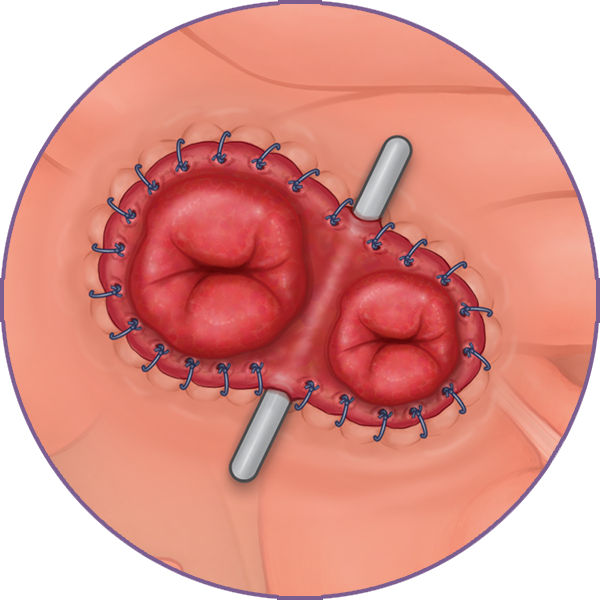 Ileostomy
