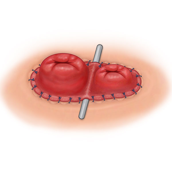 Ileostomy