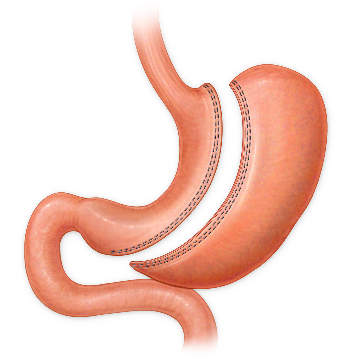 Sleeve Gastrectomy