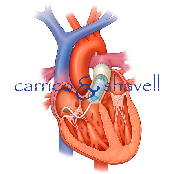 Covered CP Stent