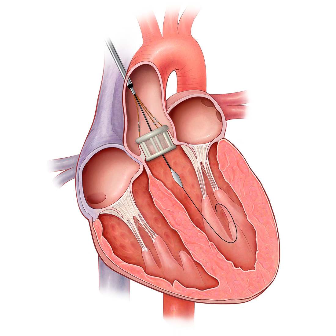 Aortic Tricuspid Artificial Heart Valve