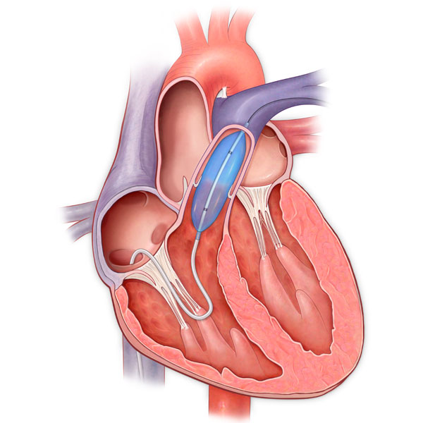 Anterior Cross Section of the Heart with Balloon and Stent