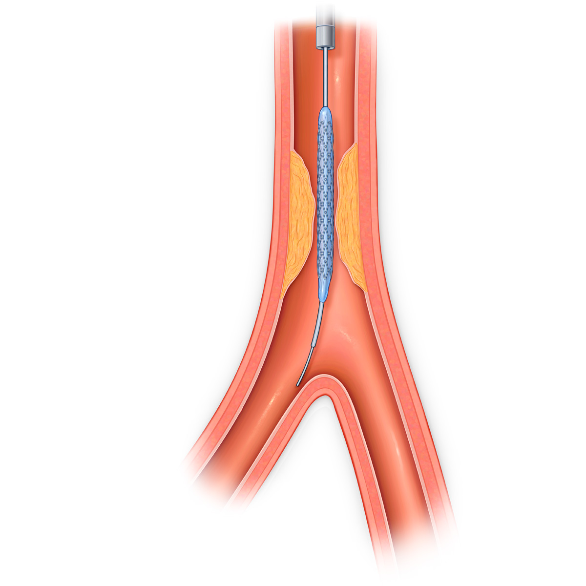 Deflated balloon catheter and stent in stenosed vessel.
