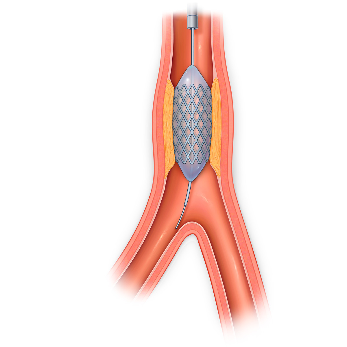 Inflated balloon catheter and stent in stenosed vessel.