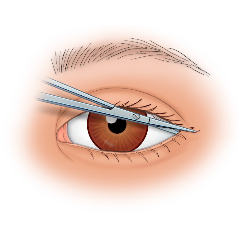 Lateral Orbital Canthotomy