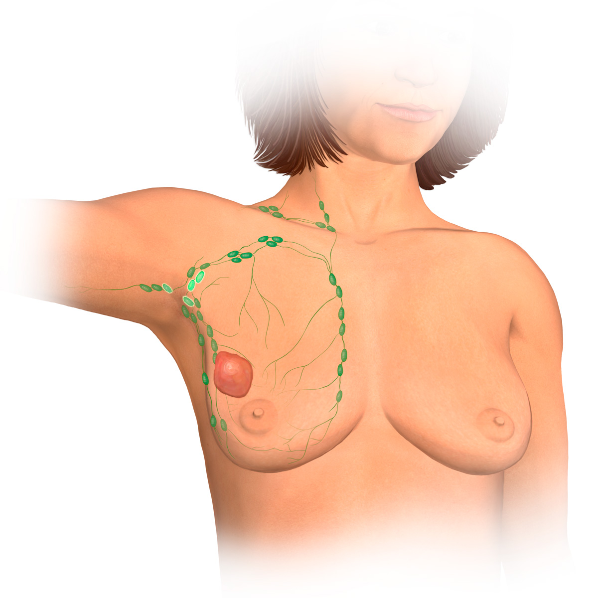 Stage IIIA T3 N1 or T0 3N2 Breast Tumor