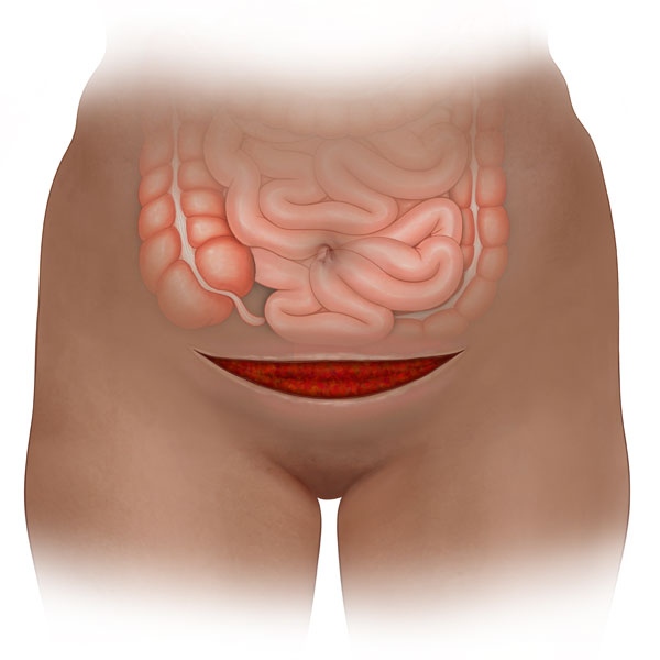 Cesarean Section