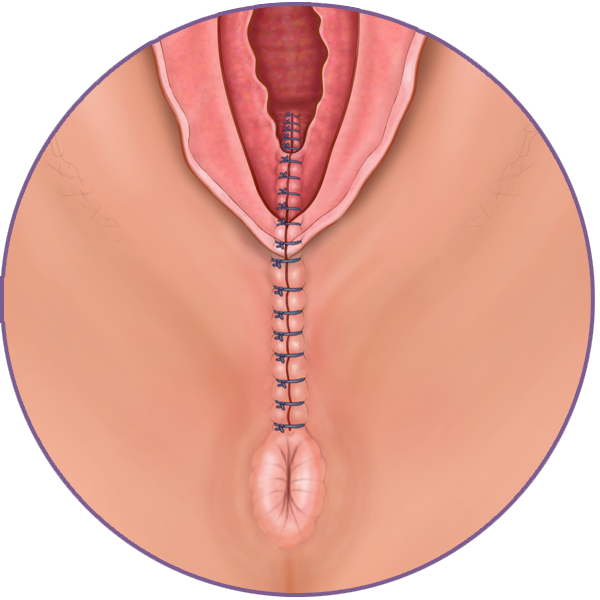 Perineal Tear Repair