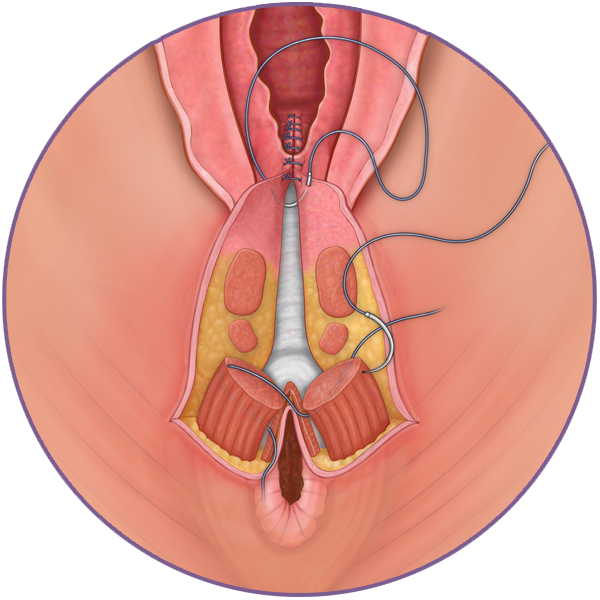 Perineal Tear Suture Repair