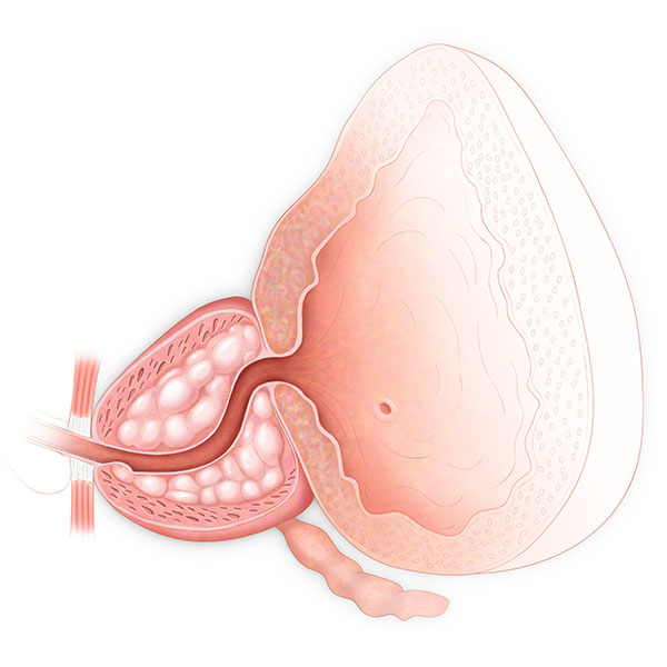 Bladder and Prostate Cross Section with Tumor