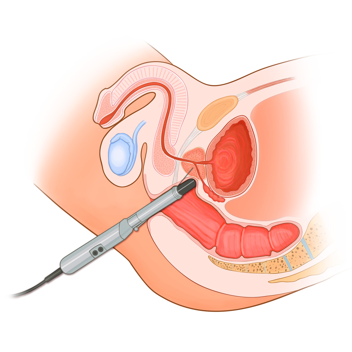 Prostate Ultrasound Exam