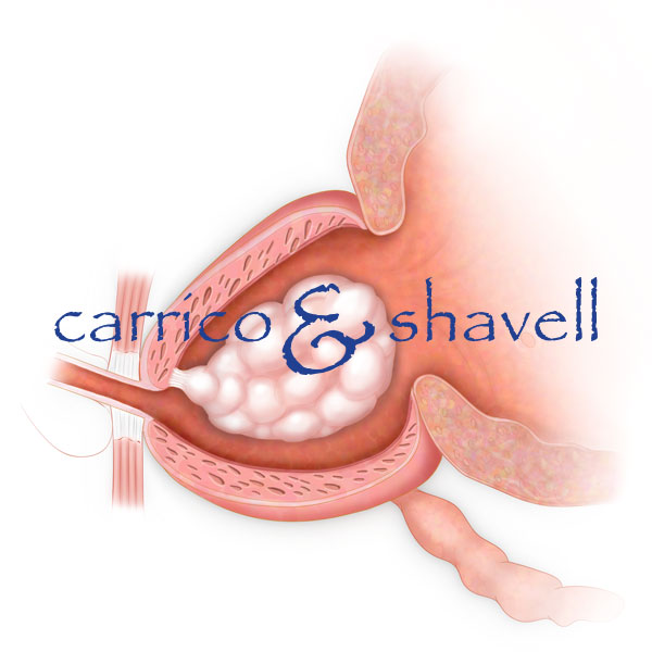 Prostate Extration, Side View