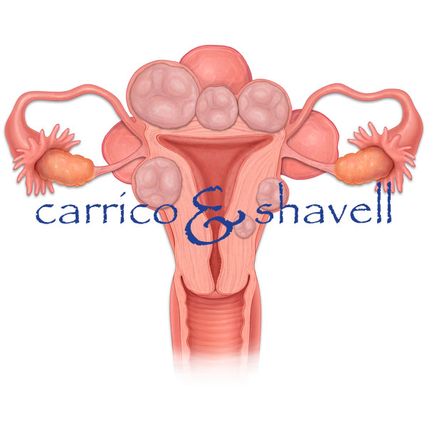 Uterine Fibroids