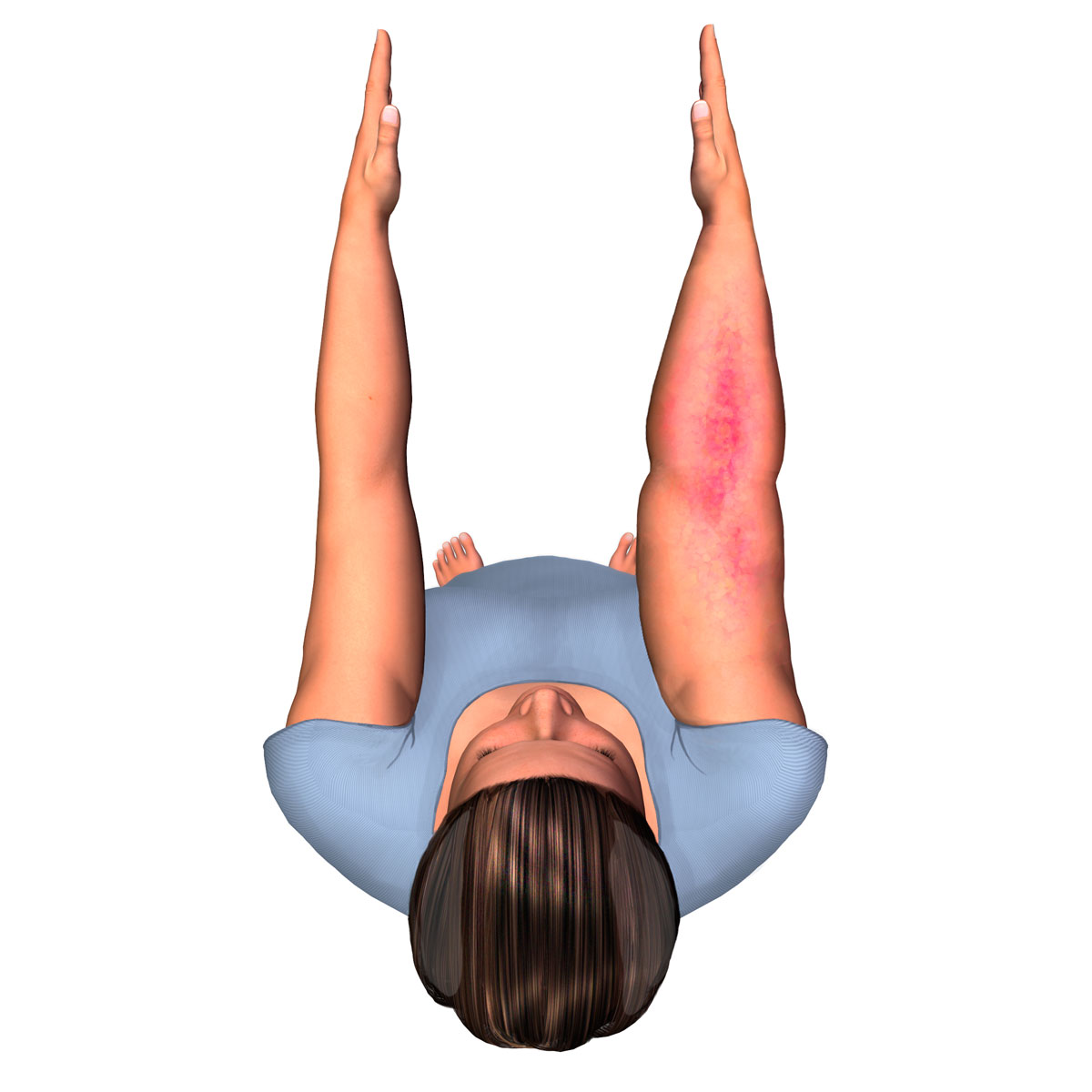 Lymphedema