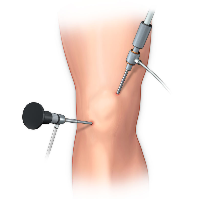 Arthroscopic Knee Portals