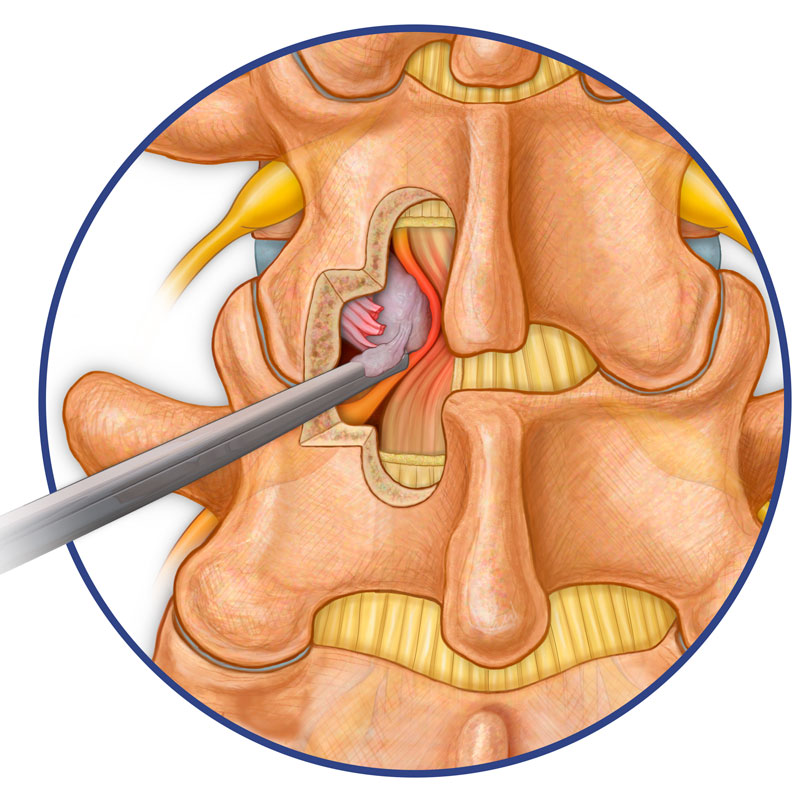 Herniated Disc Fragment