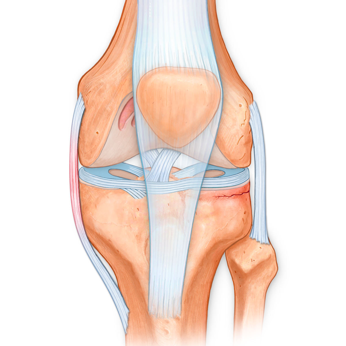 Displaced Patella