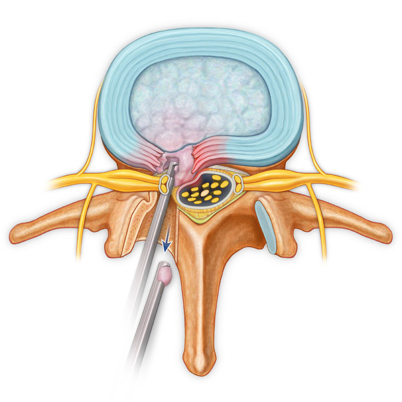 Herniated Disc Fragment Removed