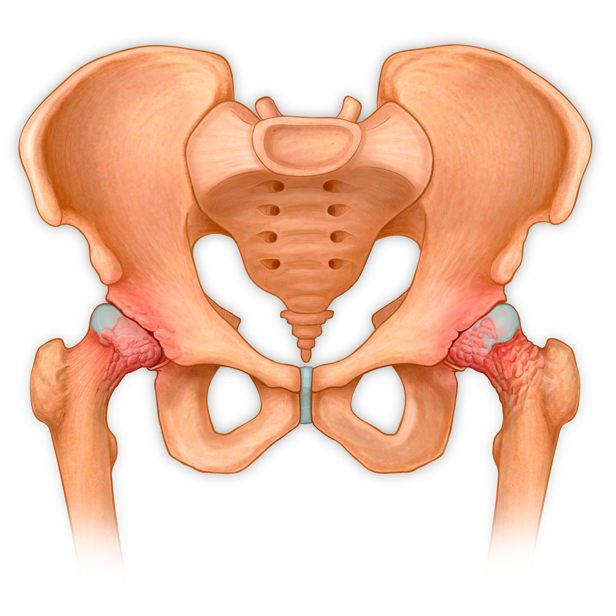 Arthritic Hip Joint and Osteophytes