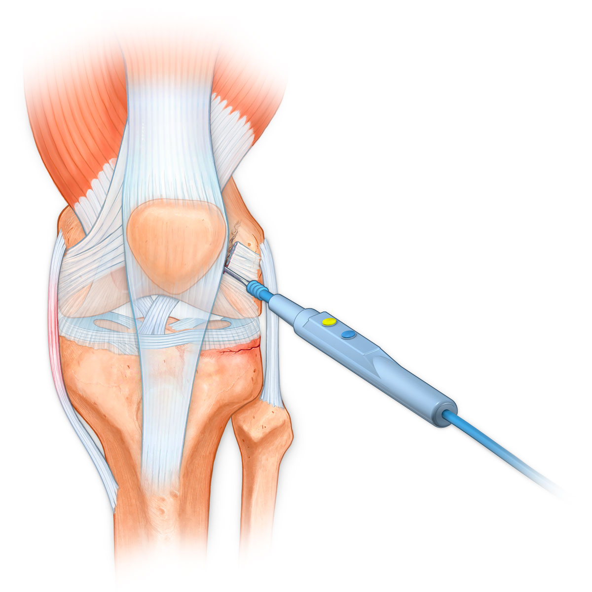 Bovie Electrosurgical Device