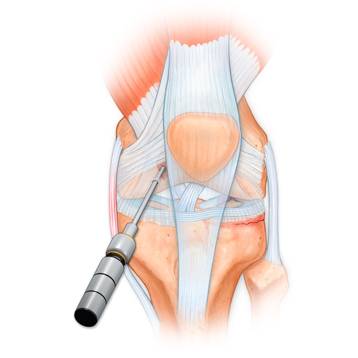 Articular Surface Chondroplasty