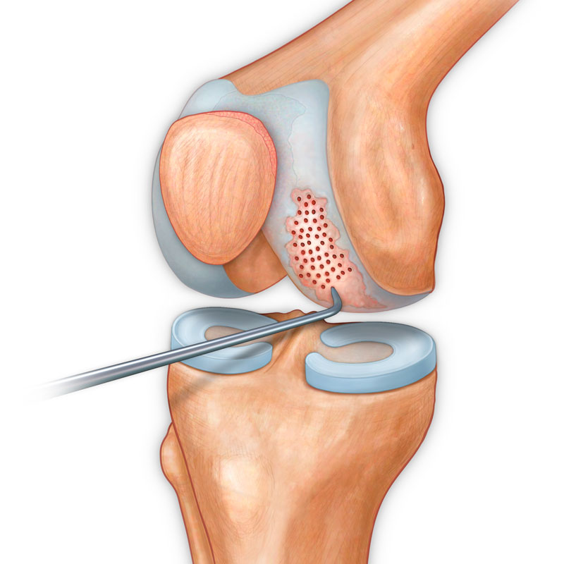Microfracture