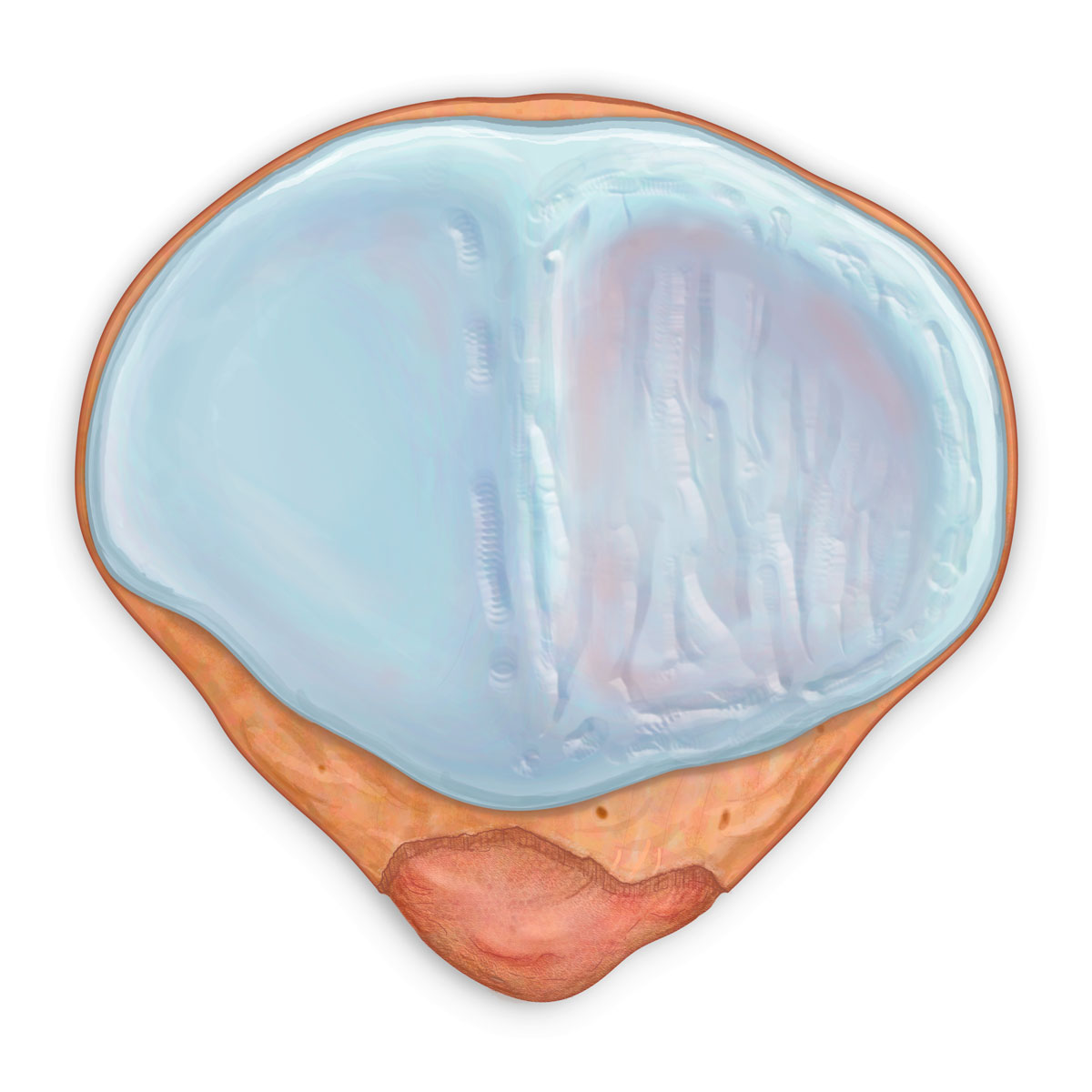 Damaged Patellar Articular Surface