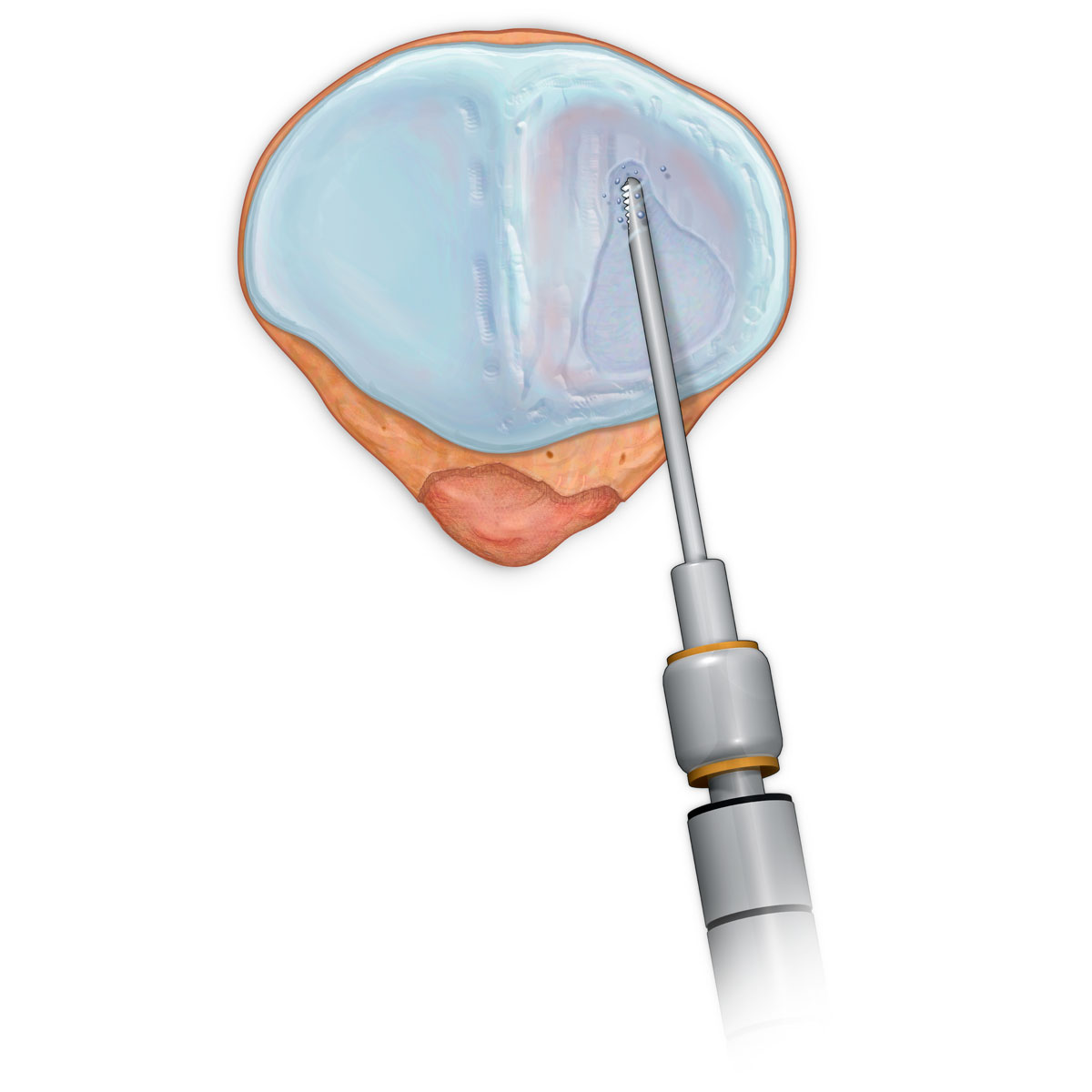 Damaged Patellar Articular Surface Repair