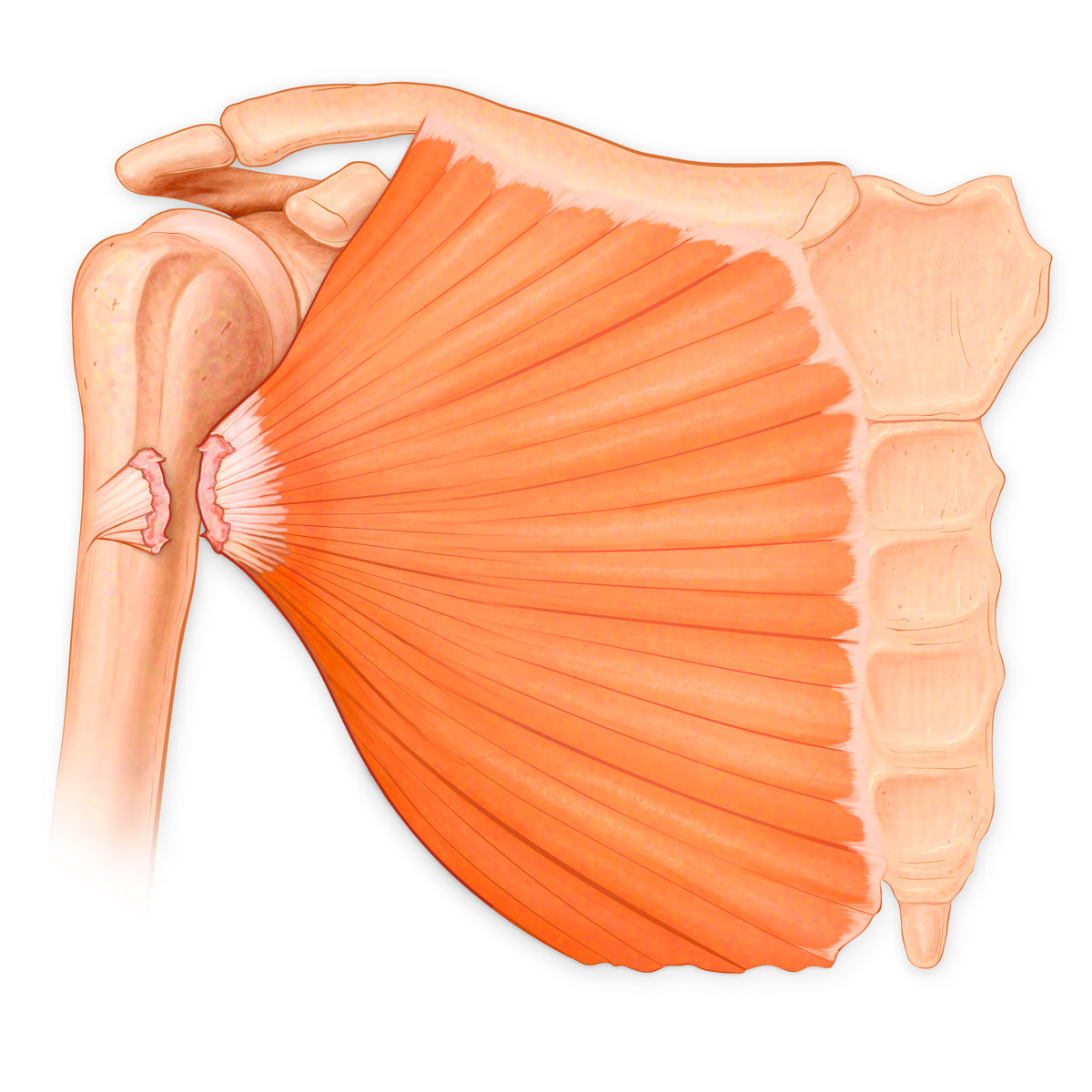 Pectoralis Major Tendon Tear
