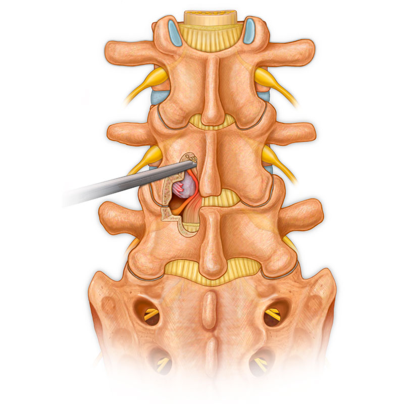 Radiculopathy Laminectomy