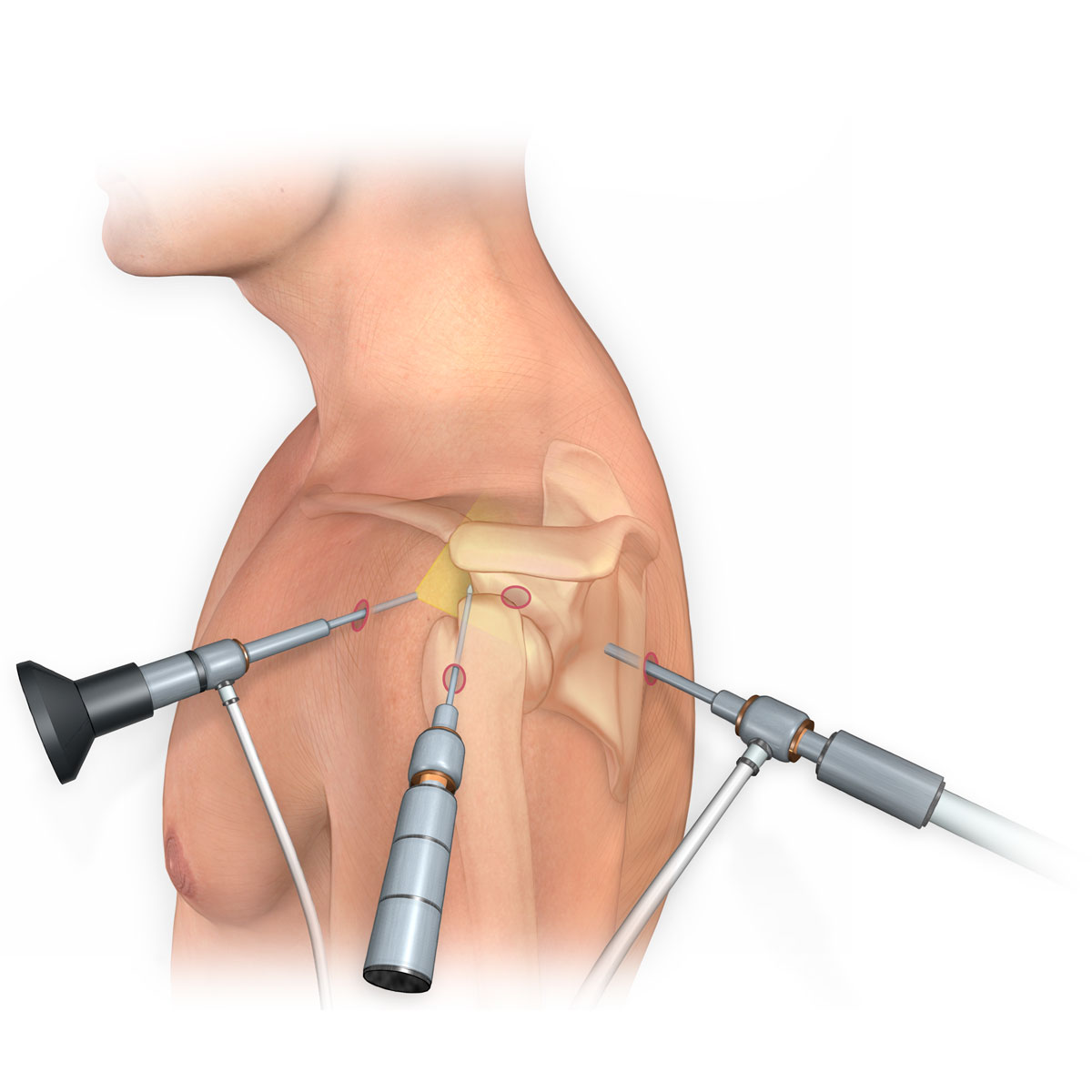 Arthroscopic Surgery Portals