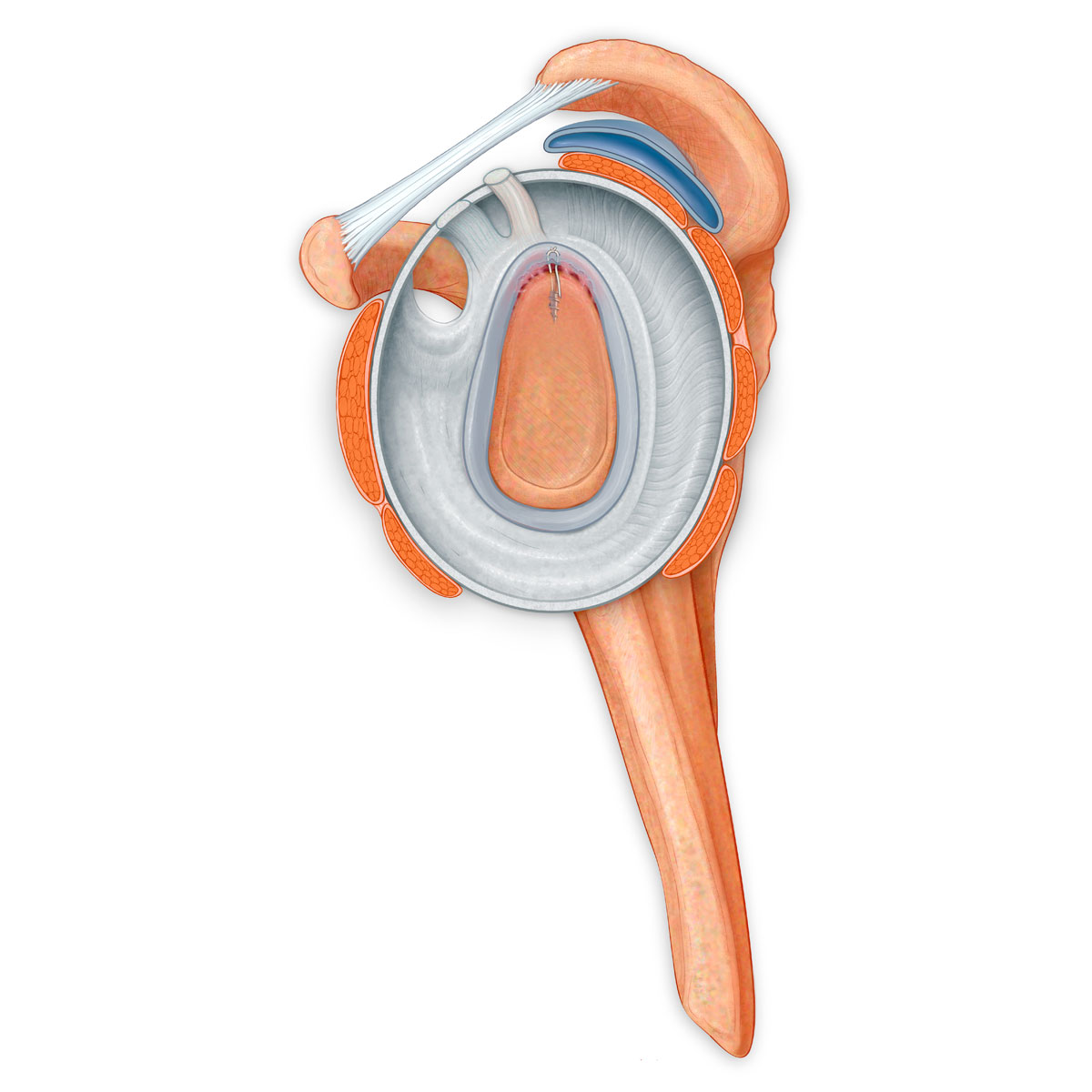 Torn Labrum Repair