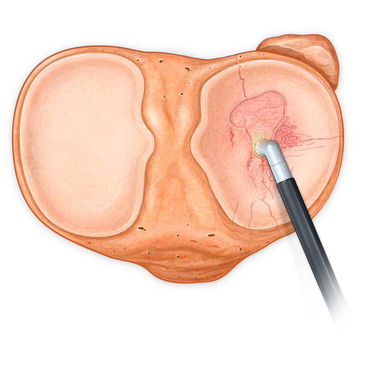 Tibial Articular Surface Coblation