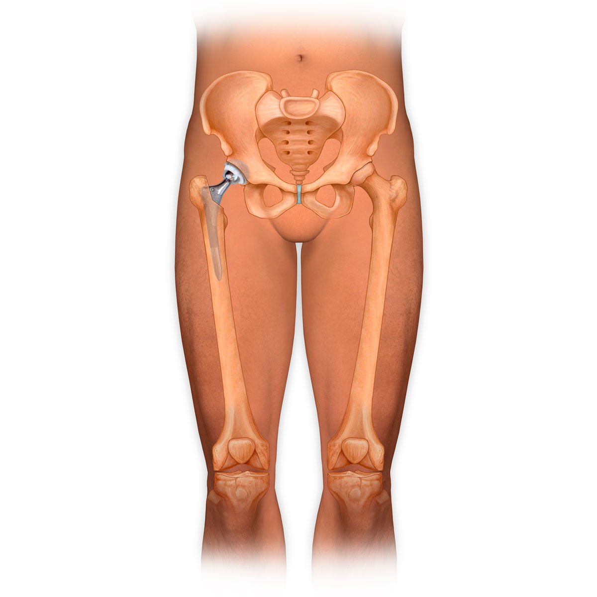 Total Hip Joint Replacement