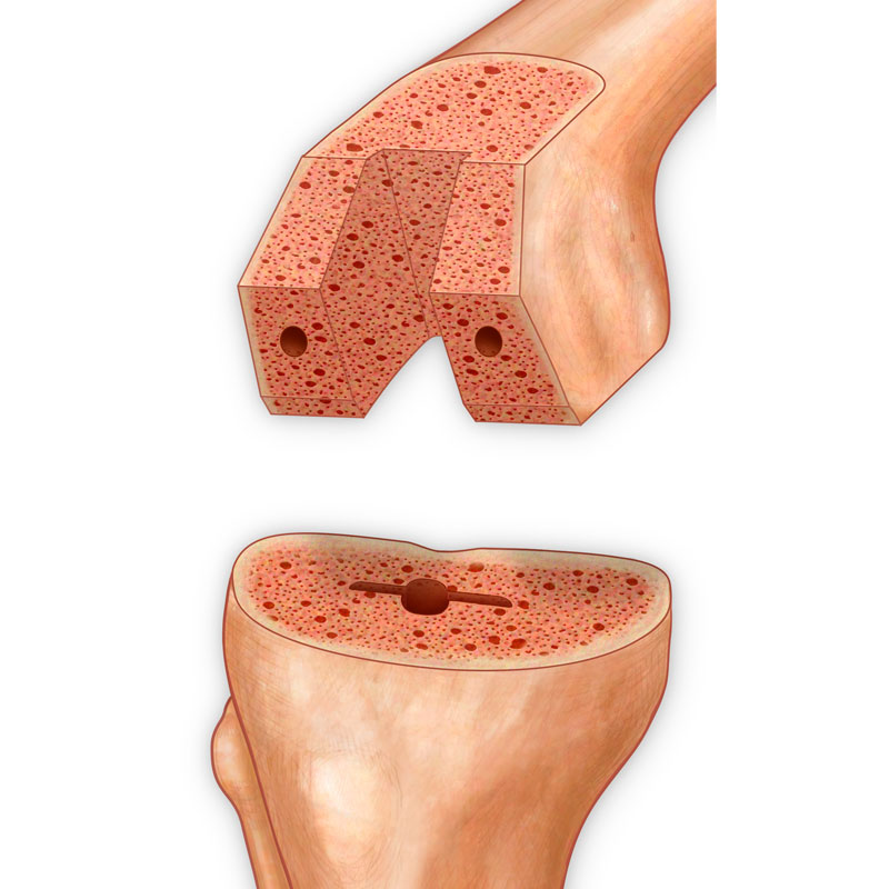 Total Knee Arthroplasty